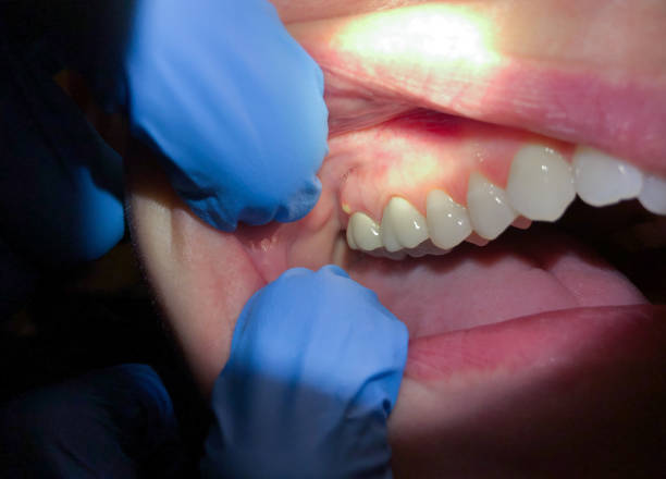 Best Emergency Dental Care for Broken or Chipped Teeth in Flora, AL